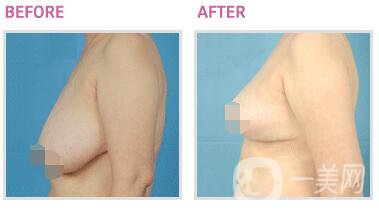 乳房太大如何縮小 乳房縮小提升手術圖片