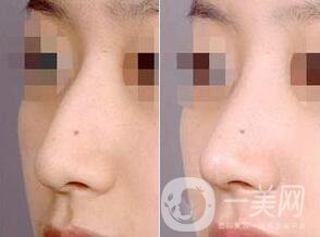 駝峰鼻矯正方法介紹 杭州駝峰鼻矯正多少錢