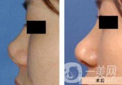 上海鼻小柱延長價格 鼻小柱延長手術(shù)多少錢