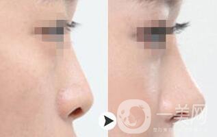 耳軟骨墊鼻尖術(shù)后護理 術(shù)后注意事項有哪些