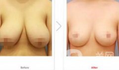 乳房縮小手術(shù)*嗎 乳房縮小有風(fēng)險嗎