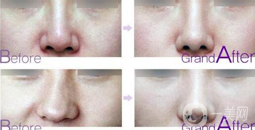 歪鼻矯正多少錢 歪鼻矯正價格盤點(diǎn)