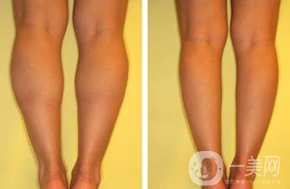 *瘦小腿多少錢 *瘦小腿價格詳情