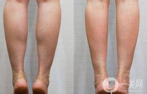 *瘦小腿多少錢 *瘦小腿價格詳情