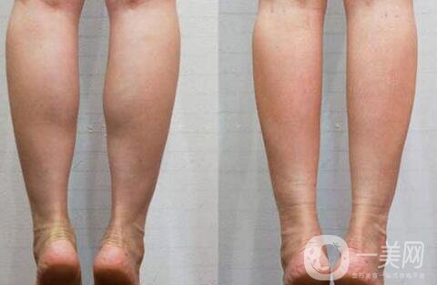 廣東注射瘦腿多少錢 注射瘦腿價(jià)格詳解