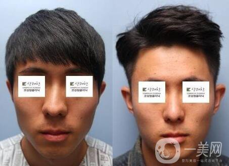 鼻歪矯正手術(shù)痛苦嗎？ 鼻歪矯正手術(shù)有多痛苦？