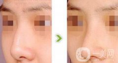 駝峰鼻矯正價(jià)錢 駝峰鼻矯正手術(shù)具體費(fèi)用