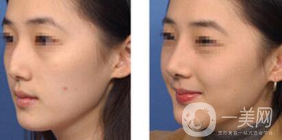 駝峰鼻矯正價(jià)錢 駝峰鼻矯正手術(shù)具體費(fèi)用