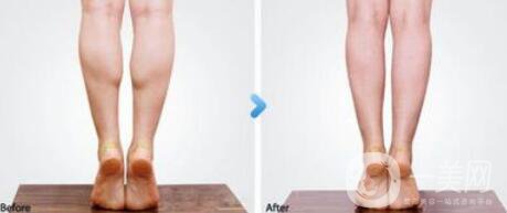 *瘦小腿*果 **怎么樣