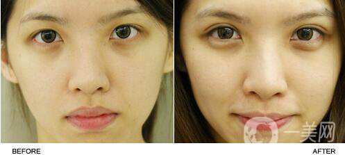 *,術(shù)后恢復(fù)過程