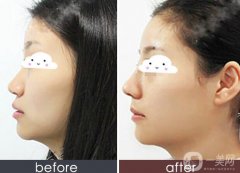 鼻部手術(shù)多久恢復(fù)自然 鼻部手術(shù)術(shù)后幾天恢復(fù)