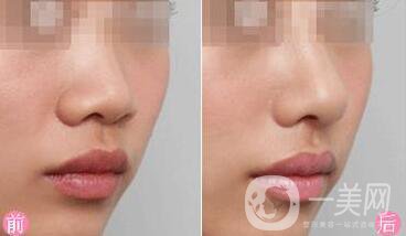 *多久恢復(fù)自然 *術(shù)后幾天恢復(fù)