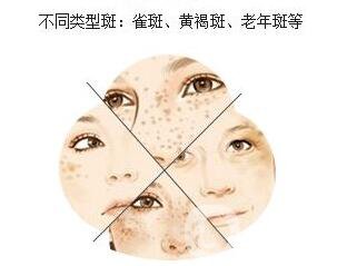 手背長老年斑怎么辦 如何去除