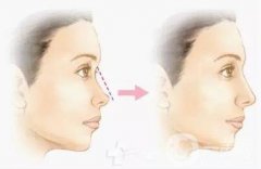 瑞蘭玻尿酸隆鼻價(jià)格 瑞蘭玻尿酸隆鼻多少錢