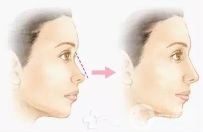 瑞蘭玻尿酸隆鼻價格 瑞蘭玻尿酸隆鼻多少錢