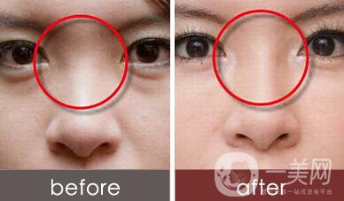 瑞蘭玻尿酸隆鼻價格 瑞蘭玻尿酸隆鼻多少錢