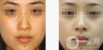 光子嫩膚的費(fèi)用 光子嫩膚具體價(jià)格