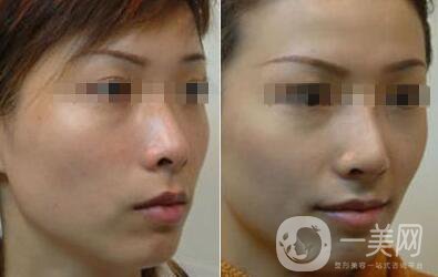 光子嫩膚的費(fèi)用 光子嫩膚具體價(jià)格