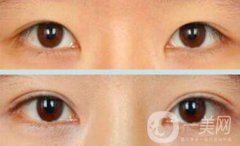 割雙眼皮疼不疼？打了麻藥還疼嗎？