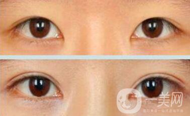 割雙眼皮疼不疼？打了麻藥還疼嗎？