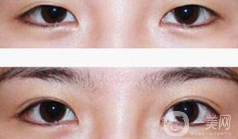 割雙眼皮疼不疼？打了麻藥還疼嗎？