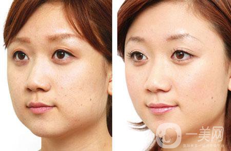 去頰脂墊多久恢復(fù) 與哪些因素有關(guān)？