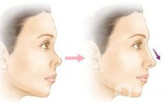 朝天鼻矯正注意事項(xiàng) 朝天鼻矯正如何護(hù)理