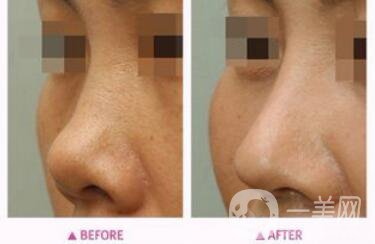 朝天鼻矯正注意事項(xiàng) 朝天鼻矯正如何護(hù)理