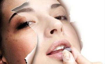 蝴蝶斑怎么去?價格一般是多少？