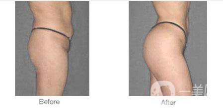 廣東豐臀手術(shù)多少錢 影響因素有哪些？