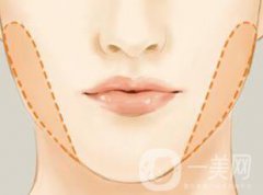 去頰脂墊多少錢 去頰脂墊價(jià)格一般是多少