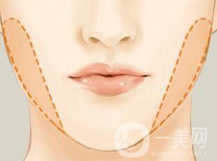 去頰脂墊,多少錢 