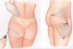 廣東臀部抽脂大概多少錢 廣東臀部抽脂價(jià)格