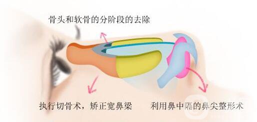 駝峰鼻矯正費用 駝峰鼻矯正價格盤點