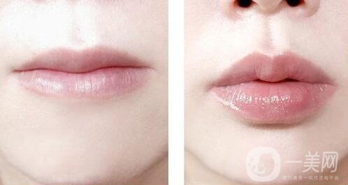 玻尿酸豐唇費用 玻尿酸豐唇多少錢