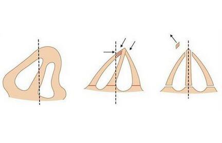 上海鼻梁骨矯正手術(shù)費(fèi)用 價(jià)格盤點(diǎn)