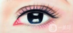 眼瞼下至多久后會回縮 眼瞼下至術后護理