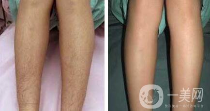 半導(dǎo)體激光脫毛價(jià)格介紹 脫毛前后照片