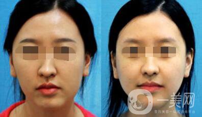 歪鼻矯正的危害 歪鼻矯正術(shù)后護理詳細介紹