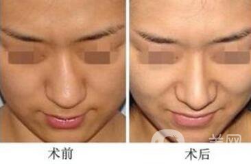 歪鼻矯正的危害 歪鼻矯正術(shù)后護理詳細介紹