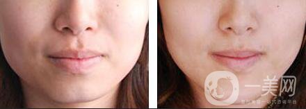 墊下巴用什么材料好 墊下巴要多少錢(qián)