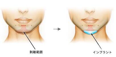 墊下巴用什么材料好 墊下巴要多少錢(qián)
