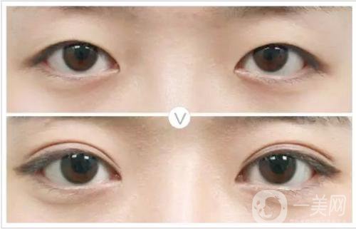 割雙眼皮和埋線哪個*果比較好？
