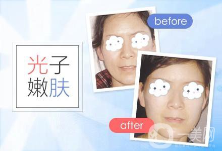 做光子嫩膚術(shù)*果到底好不好