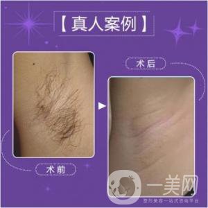 激光脫毛多少錢一次比較合理？