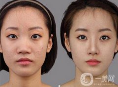 北京鼻部手術(shù)整形多少錢 和哪些因素有關(guān)？