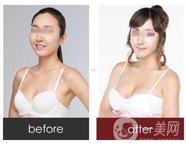 妙桃隆胸費(fèi)用 價(jià)格詳情一覽