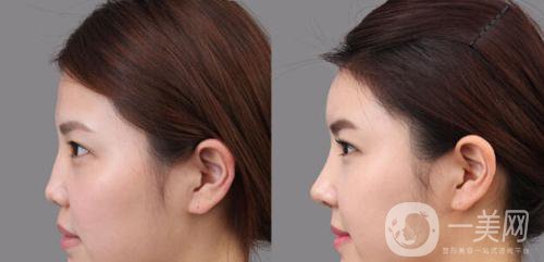 深圳*隆鼻大概多少錢 參考價(jià)格分析