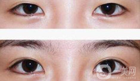 八月割雙眼皮會發(fā)炎嗎 雙眼皮術后護理事項介紹