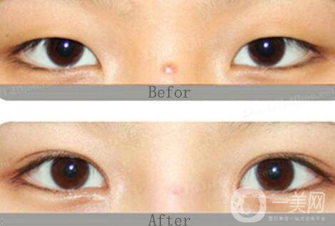 八月割雙眼皮會發(fā)炎嗎 雙眼皮術后護理事項介紹